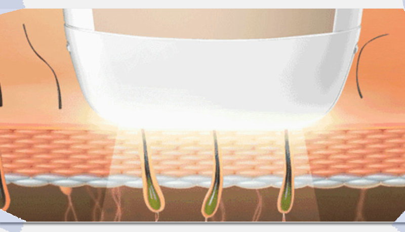 家用脫毛儀跟美容院的有什么區別