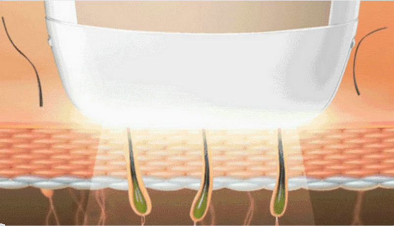 家用脫毛儀，脫毛更簡單