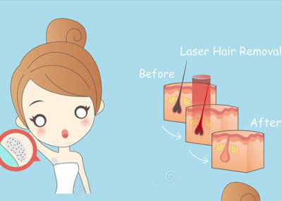 6個讓你選擇秀美特家用光子脫毛儀的理由