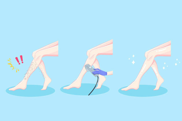 脫毛儀器生產廠家