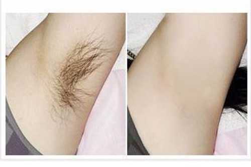 關(guān)于家用光子脫毛儀的小秘密（四）(圖1)