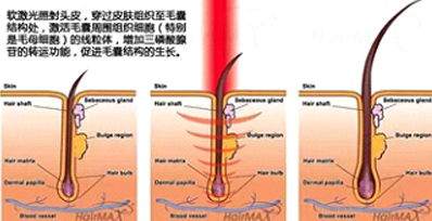 永久脫毛有哪些方式和對比效果(圖1) 永久脫毛有哪些方式和對比效果(圖1)