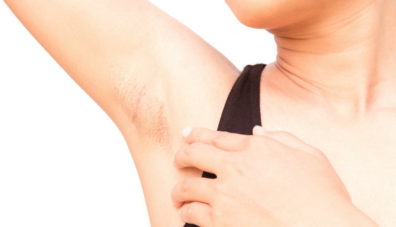 去腋毛會不會引起狐臭？有什么直接聯系嗎？(圖2)